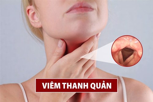 Những triệu chứng của bệnh viêm thanh quản là gì để xử lý sớm?