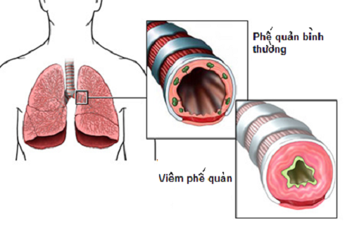 Tái cấu trúc đường thở là gì và ảnh hưởng như thế nào đến sức khỏe?