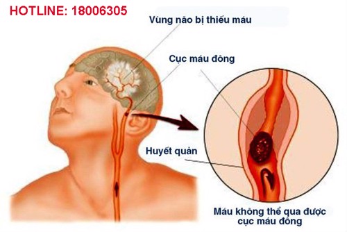 Nhồi máu não bán cầu trái: Nguyên nhân là gì và điều trị như thế nào?