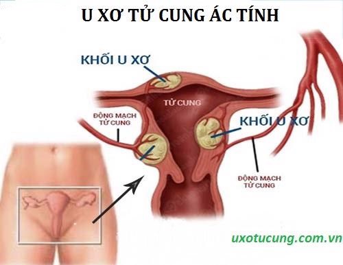 U xơ tử cung ác tính nguy hiểm như thế nào? Hãy xem ngay!