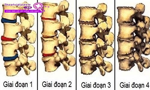 Thoái hóa cột sống lưng có chữa được không? 