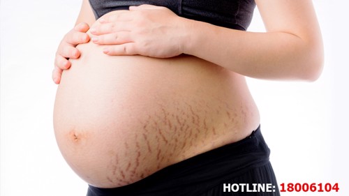 Có 4 yếu tố này, nguy cơ rạn da khi mang thai rất cao – Chị em nhớ phòng ngừa sớm!