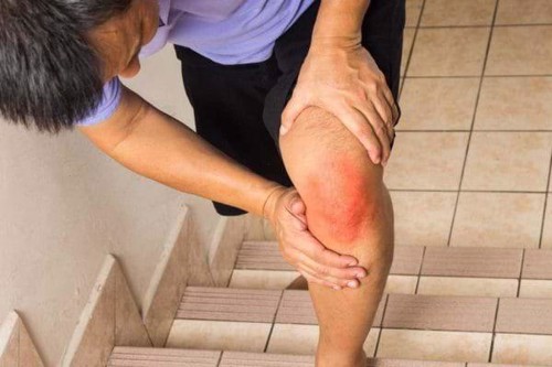 Tràn dịch khớp gối và phương pháp điều trị - Xem ngay để biết!
