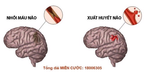 Điều trị tai biến mạch máu não giai đoạn cấp cần lưu ý những gì?