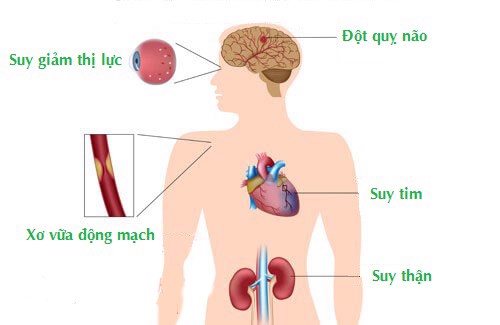 Bị tai biến do tăng huyết áp phải làm sao? Dùng Định Áp Vương hỗ trợ phòng ngừa có được không?