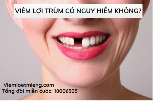 Bệnh viêm lợi trùm có nguy hiểm không? Tìm hiểu ngay dưới đây!