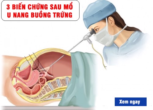 3 biến chứng sau mổ u nang buồng trứng và cách phòng bệnh tái phát bằng sản phẩm thảo dược