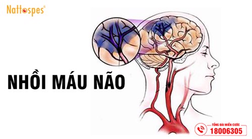 Nhồi máu não có hồi phục được không? – Thông tin về bệnh nhồi máu não