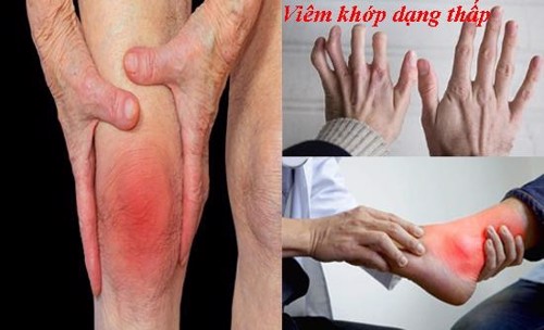 NGƯỜI BỊ VIÊM KHỚP DẠNG THẤP NÊN ĂN GÌ ĐỂ TỐT CHO SỨC KHỎE? Xem ngay tại đây!