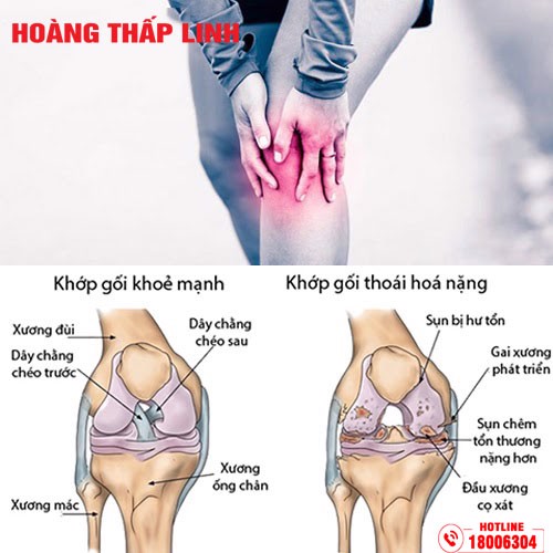 Thoái hóa khớp: Phương pháp chẩn đoán và điều trị. Xem ngay kẻo lỡ!