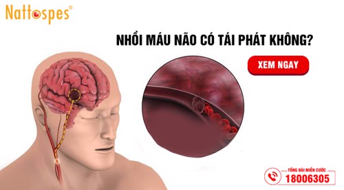 Nhồi máu não có tái phát không? – Xu hướng ngăn ngừa và cải thiện nhồi máu não từ thảo dược