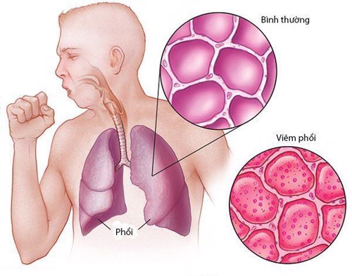 Tiết lộ nguyên nhân gây ho đờm mãi không khỏi và biện pháp khắc phục