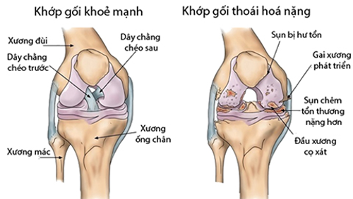  5 cách phòng ngừa thoái hóa khớp mà ai cũng phải biết! Click xem ngay!