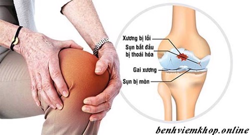Bị viêm khớp gối có nên tập thể dục, đi bộ, chạy bộ không? Câu trả lời sẽ có tại đây!