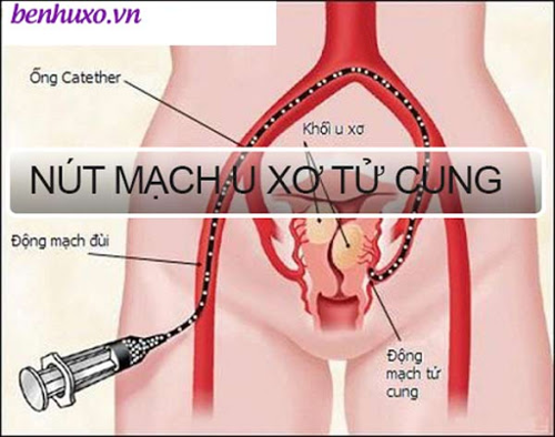 Phương pháp nút mạch u xơ tử cung và những điều bạn cần biết