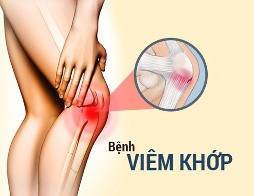 Giải pháp giúp tăng cường miễn dịch, giảm đau, chống viêm thực vật hỗ trợ điều trị viêm sưng khớp?  