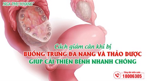  Cách giảm cân khi bị buồng trứng đa nang và thảo dược giúp cải thiện bệnh nhanh chóng