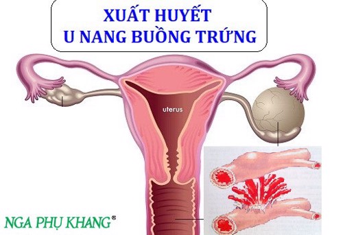 Tác dụng của Nga Phụ Khang trong phòng ngừa, hỗ trợ điều trị u xơ tử cung, u nang buồng trứng