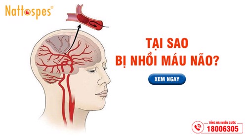 Tại sao bị nhồi máu não? – Lý giải nguyên nhân và phương pháp cải thiện nhờ sản phẩm thiên nhiên