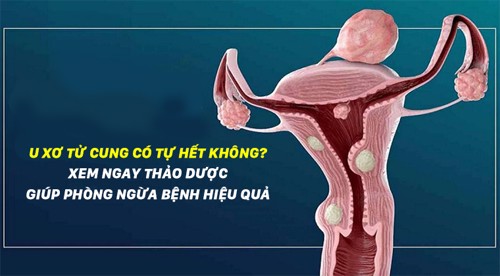 U xơ tử cung có tự hết không? Xem ngay thảo dược giúp phòng ngừa, cải thiện bệnh hiệu quả