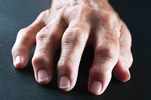 Tiêu chí lựa chọn sản phẩm tốt cho người bệnh viêm khớp là gì?