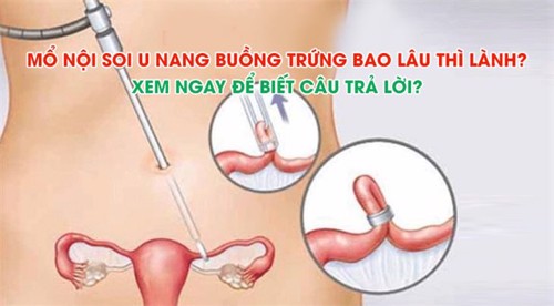  Mổ nội soi u nang buồng trứng bao lâu thì lành? Xem ngay để biết câu trả lời?