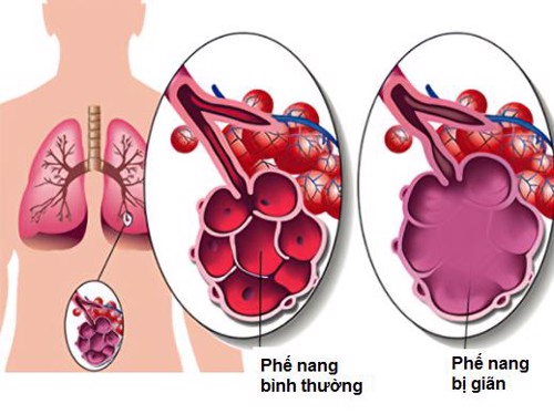 Người bị viêm phế quản mạn tính, khó thở, đã uống thuốc không đỡ cần phải làm gì?