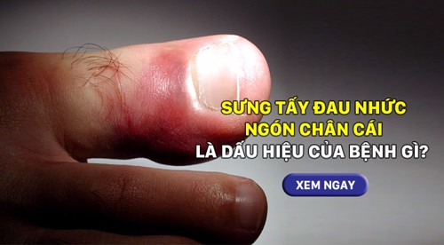 Sưng tấy đau nhức ngón chân cái là dấu hiệu của bệnh gì? Xem ngay!