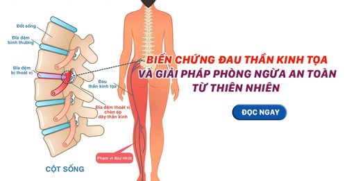 Biến chứng đau thần kinh tọa và giải pháp phòng ngừa an toàn từ thiên nhiên