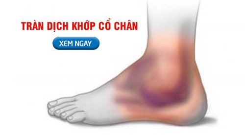 Tràn dịch khớp cổ chân là gì? Nguyên nhân và cách điều trị từ thảo dược