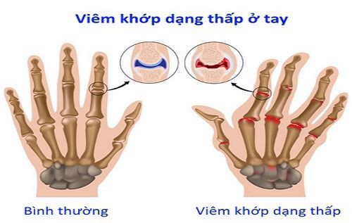 Viêm khớp dạng thấp có chữa khỏi được không?