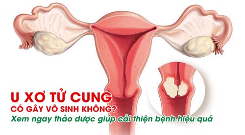 U xơ tử cung có gây vô sinh không? Xem ngay thảo dược giúp cải thiện bệnh hiệu quả