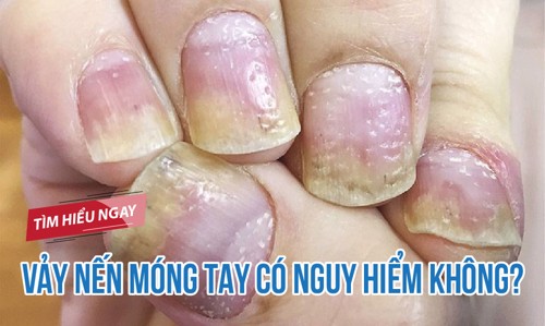 Vảy nến móng tay có nguy hiểm không? TÌM HIỂU NGAY!