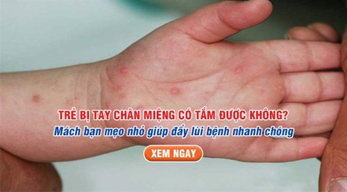 Trẻ bị tay chân miệng phải kiêng gì? Xem ngay tại đây!