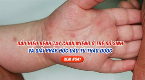 Dấu hiệu bệnh tay chân miệng ở trẻ sơ sinh và giải pháp độc đáo từ thảo dược