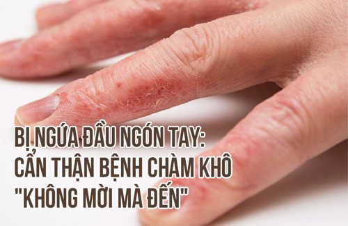 Bị ngứa đầu ngón tay: Cẩn thận bệnh chàm khô "không mời mà đến"