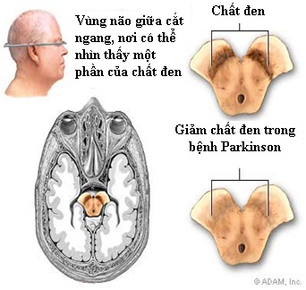 Vai trò của Dopamin trong bệnh Parkinson