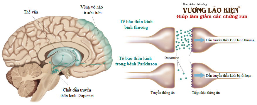 Ba mục tiêu lớn trong điều trị Parkinson
