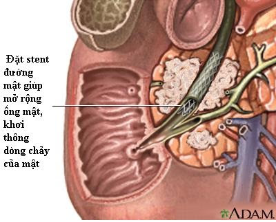 Đặt stent giúp điều trị tắc nghẽn đường mật