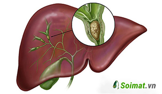 Sỏi đường mật trong gan dễ gây tắc nghẽn đường ống dẫn mật và gây ra nhiều biến chứng nguy hiểm