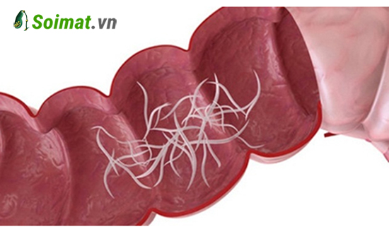 Ký sinh trùng đường ruột (giun, sán) là nguyên nhân phổ biến nhất hình thành sỏi gan