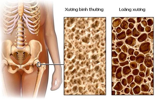 Loãng xương làm tăng nguy cơ mắc bệnh sỏi mật