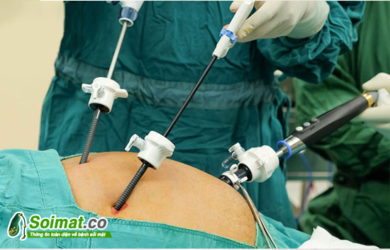 Phương pháp nội soi ổ bụng lấy sỏi chỉ cần đưa thiết bị qua rốn của người bệnh