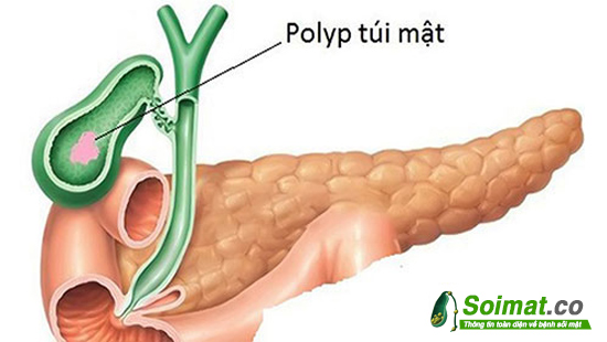 Điều trị polyp túi mật đúng cách sẽ giúp giảm nguy cơ tiến triển thành ung thư.
