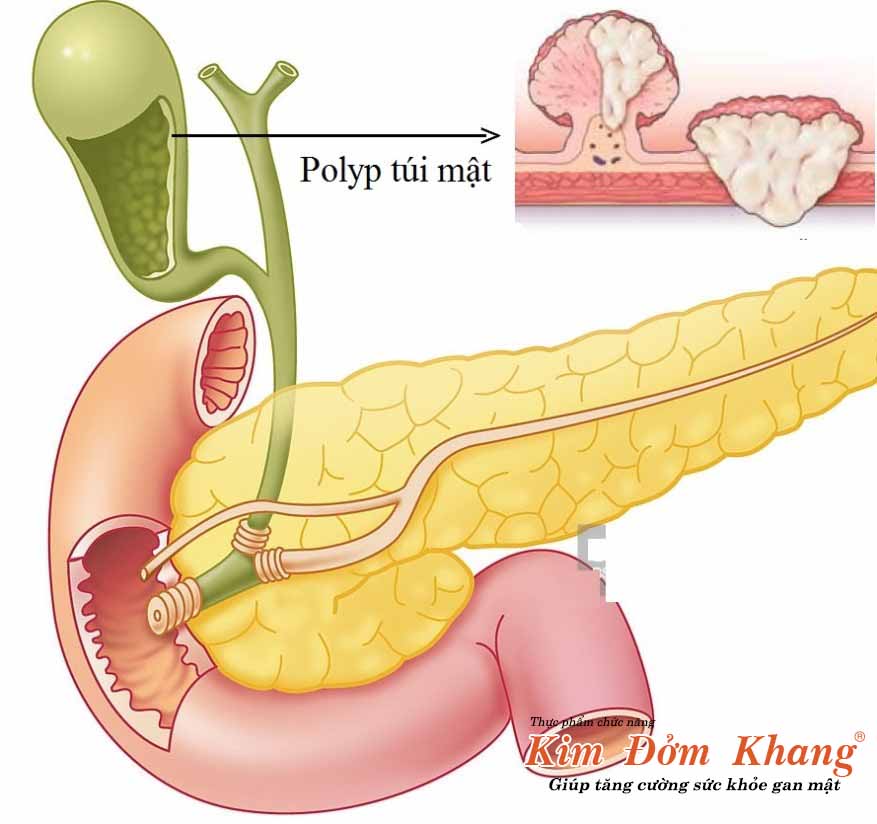 Mổ polyp túi mật - giải pháp tránh polyp tiến triển ung thư
