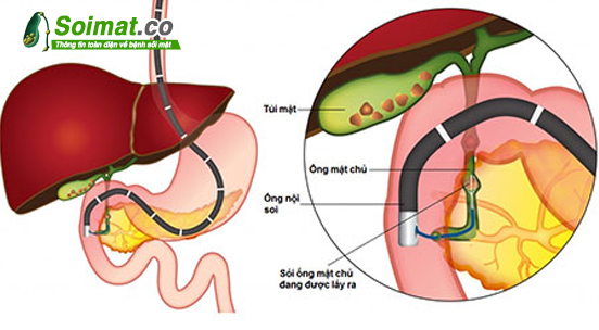 Sỏi ống mật chủ thường được điều trị bằng phương pháp nội soi mật tụy ngược dòng