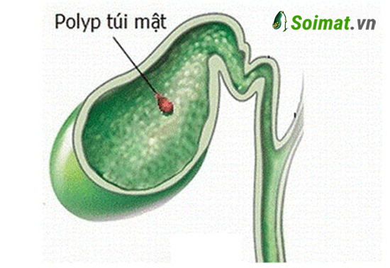 Thông tin từ A đến Z về bệnh polyp túi mật