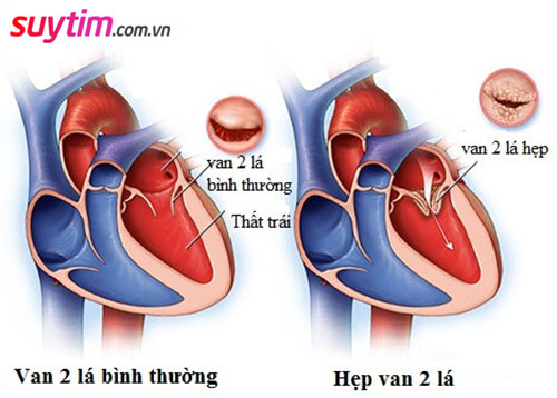 Hẹp van tim 2 lá: Tất cả thông tin cần biết để điều trị hiệu quả