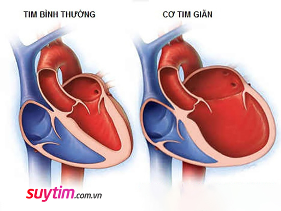 3 Dạng suy tim thường gặp - nguyên nhân và diễn biến