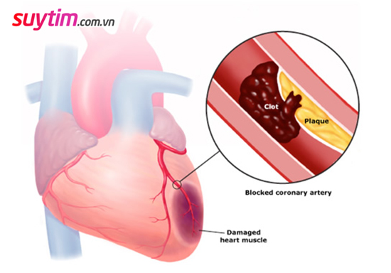Đau tim, nhồi máu cơ tim và các dấu hiệu cảnh báo sớm